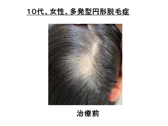 円形脱毛症　病院